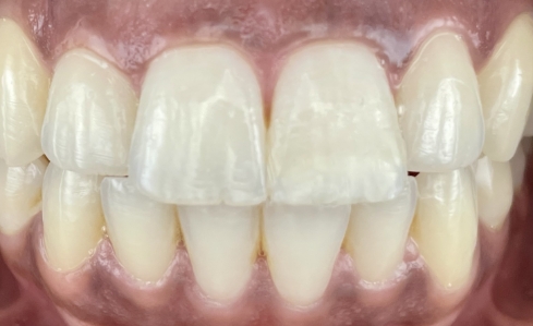 Close up of mouth with flawless teeth after dental treatment