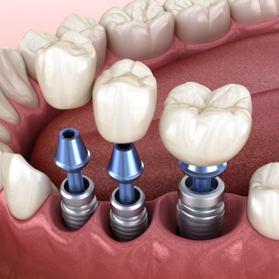 Illustration of three dental crowns being placed onto three dental implants