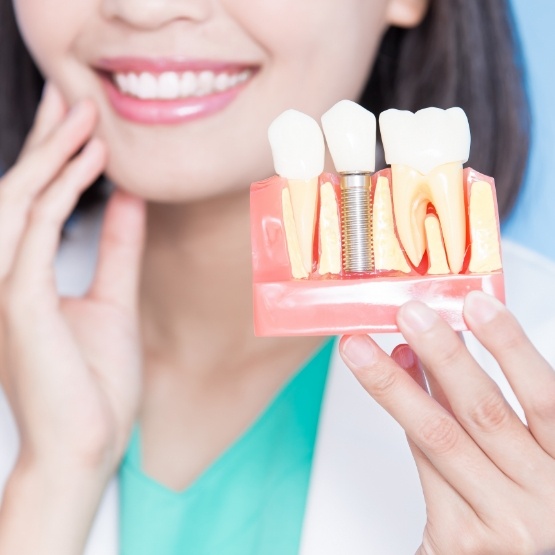 Dentist holding a model of a dental implant