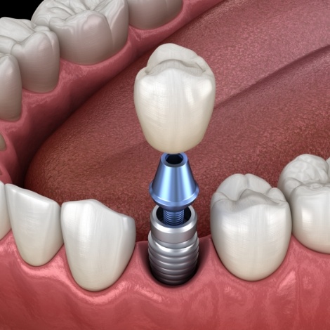 Illustrated dental crown being fitted onto a dental implant