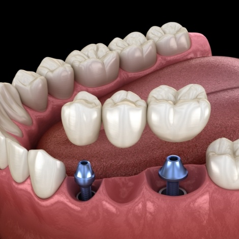 Illustrated dental bridge being fitted onto two dental implants