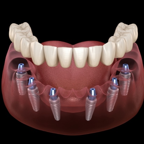 Illustrated full denture being fitted onto six dental implants