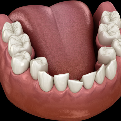 Illustration of crowded teeth