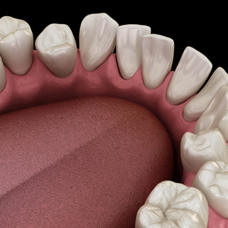 Illustration of notable gaps between teeth