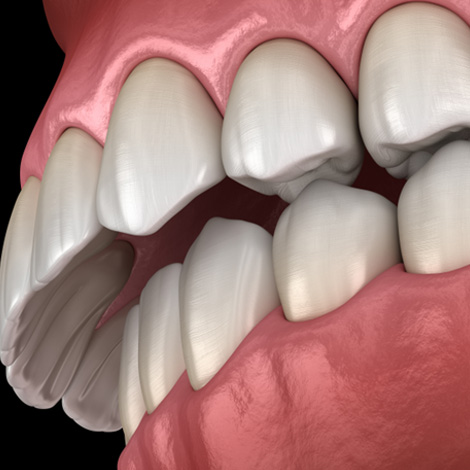 Illustration of an overbite