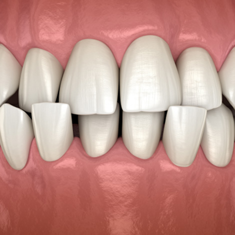 Illustration of a crossbite