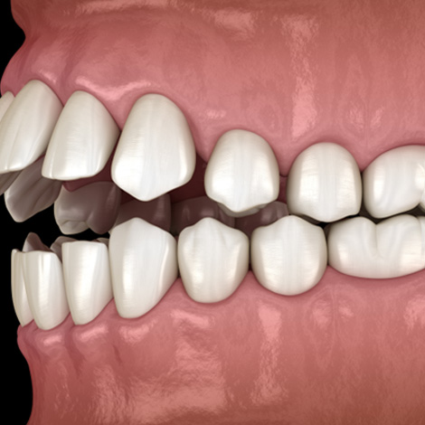 Illustration of an open bite