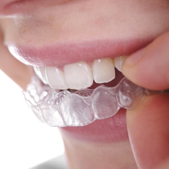 Close up of a person placing an Invisalign aligner over their teeth
