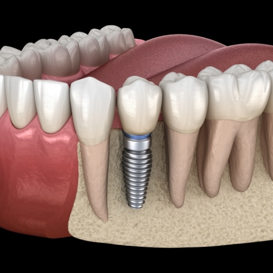 Illustrated dental implant replacing a missing tooth