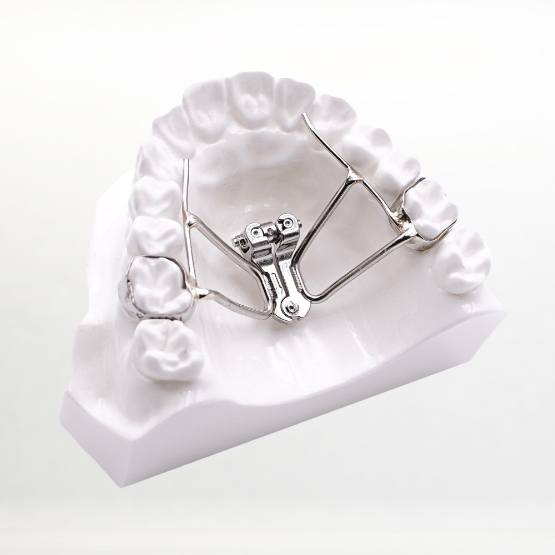 Metal wire palatal expander on model of the upper jaw