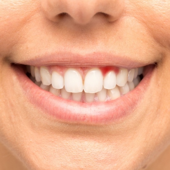 Close up of smile with red spot in the gums