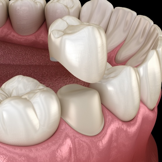 Illustrated dental crown being placed over a tooth