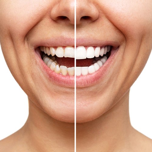 Patient's smile before and after veneers